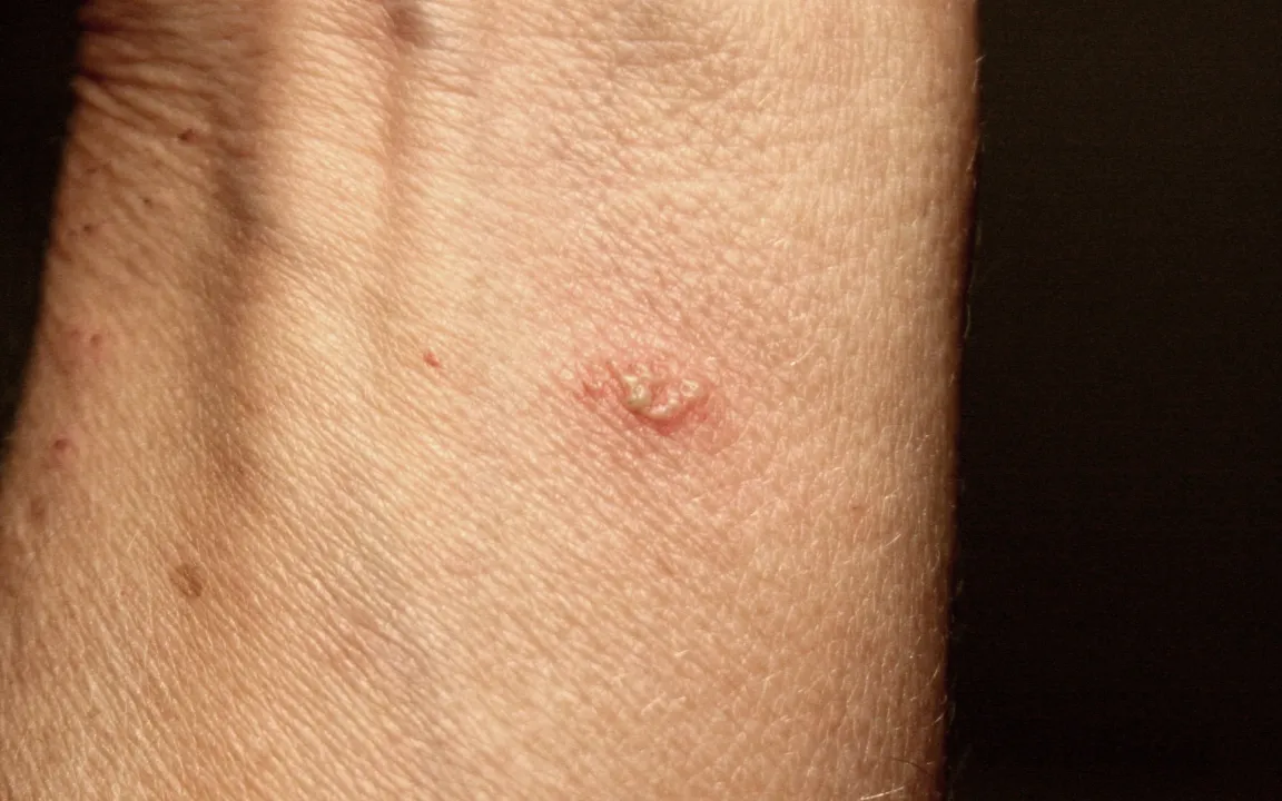 Vorsicht geboten: Phototoxische Giftpflanzen im Garten