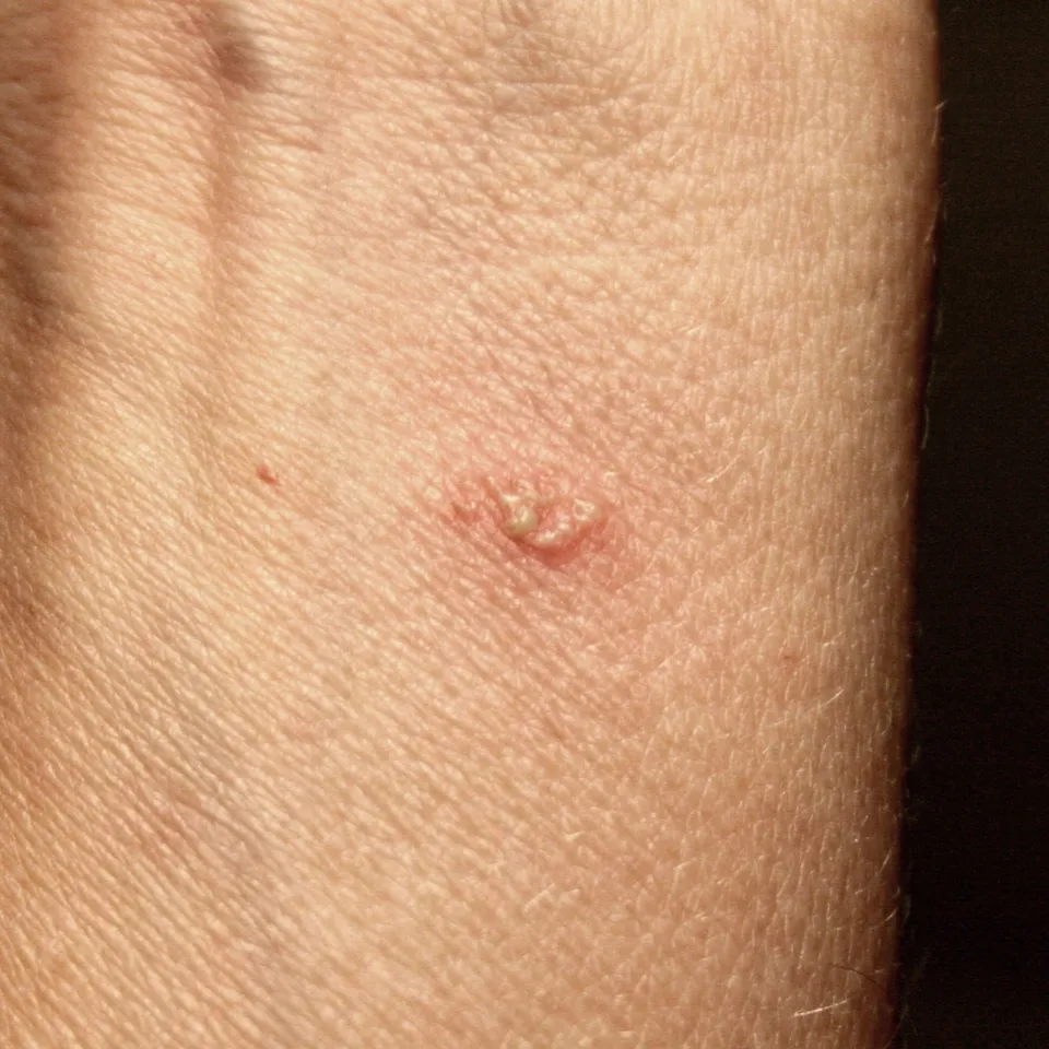 Vorsicht geboten: Phototoxische Giftpflanzen im Garten